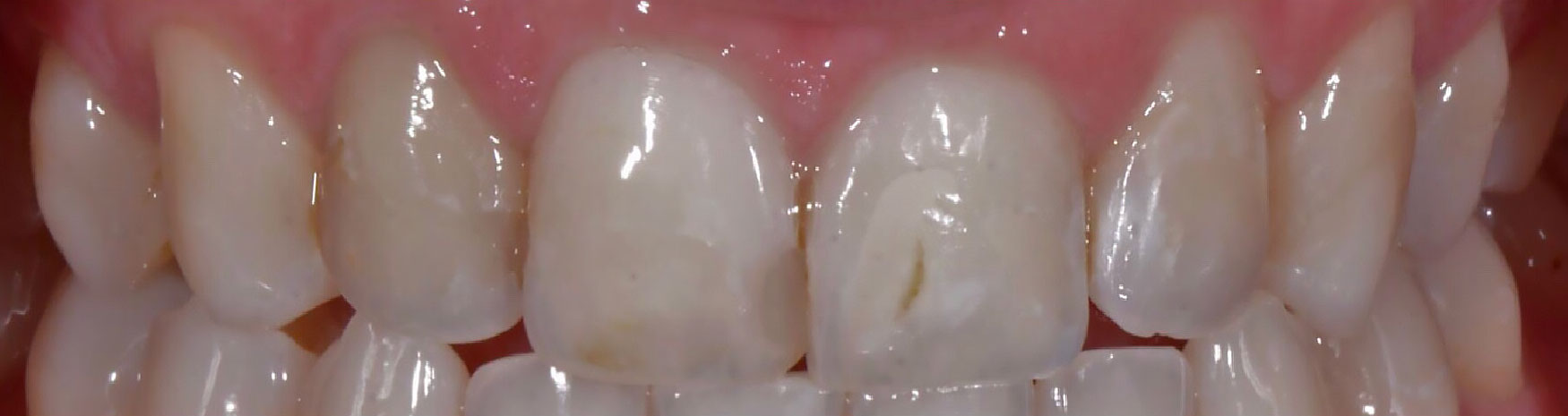 dental restoration case before